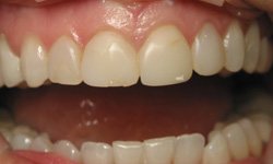 Chipped top teeth before cosmetic dentistry