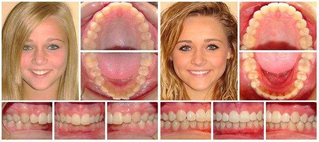 Invisalign Fort Worth | Cosmetic Dentist | Hulen Dental
