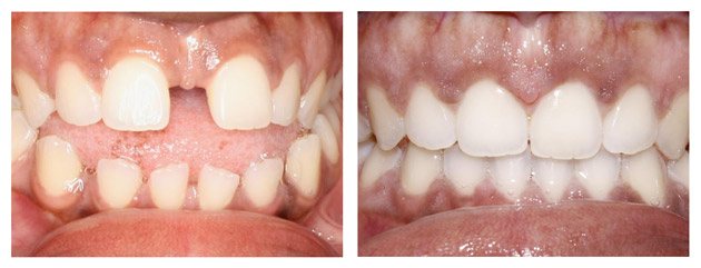 invisalign before teeth treatment gap rotated crowding worth dental smile spacing smiles correction help anterior fort center dr transformation