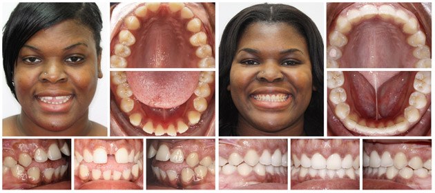 invisalign teeth gap crowding rotated correction fort worth spacing