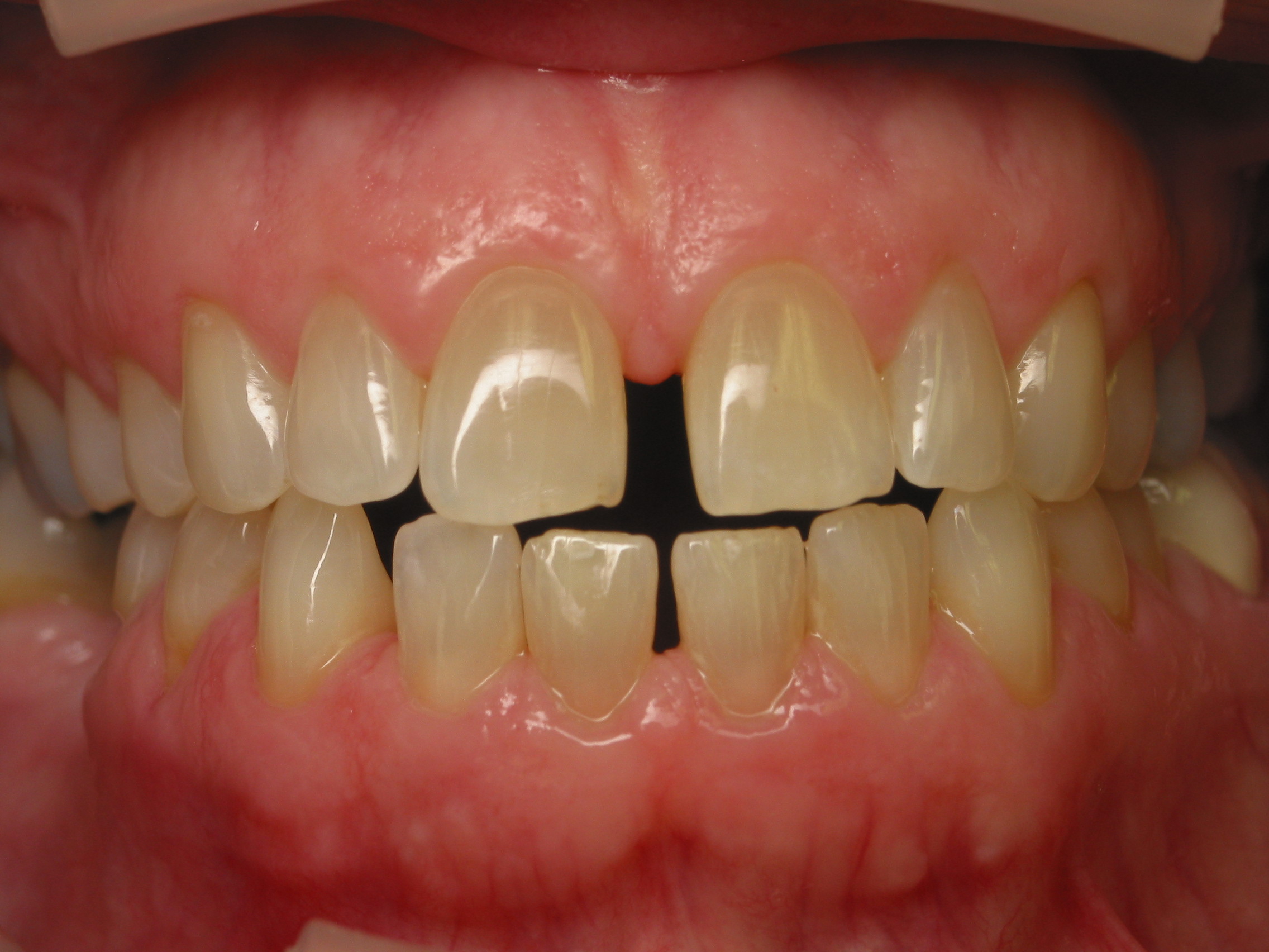 i had braces and my teeth shifted i had braces and my teeth shifted