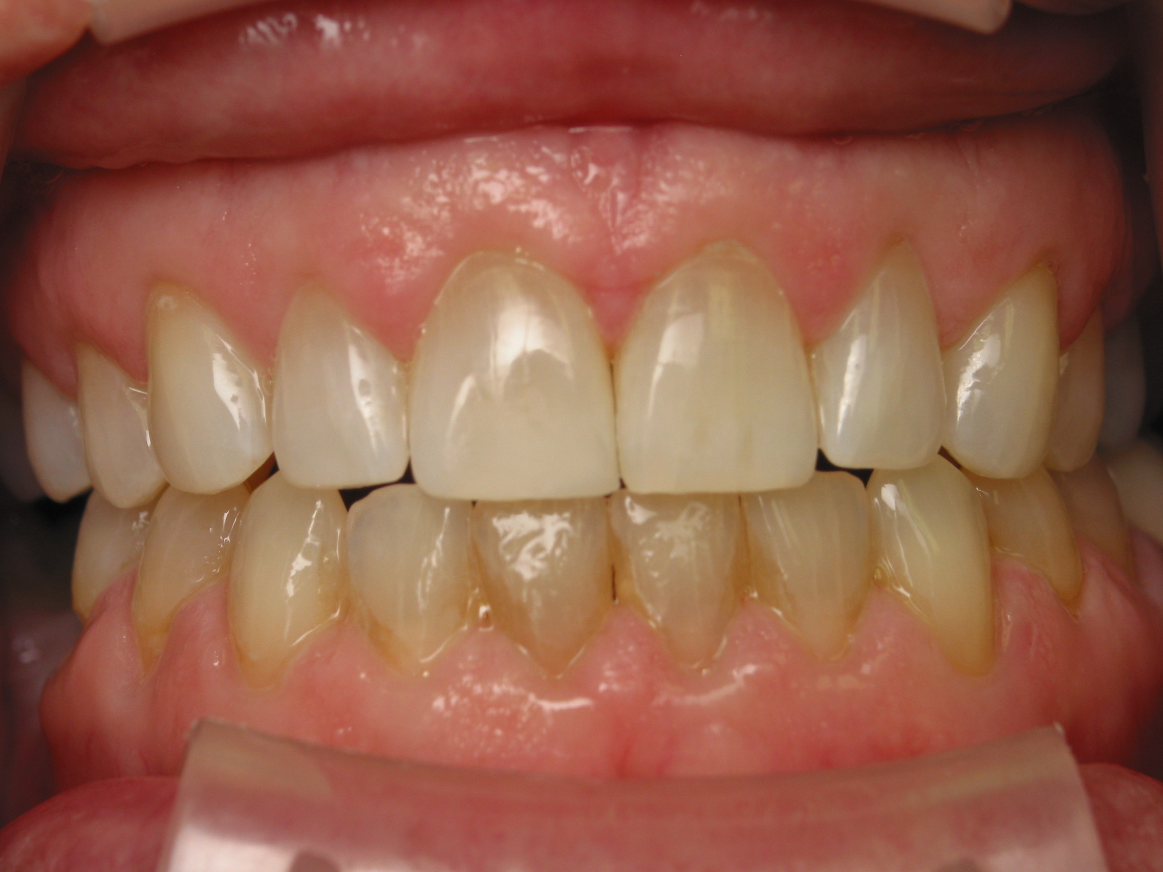 shifted teeth after braces shifted teeth after braces