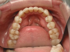 img_09822 After Just One Year With Invisalign !