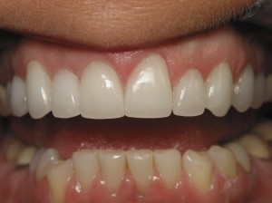 Longer, more natural and younger-looking teeth Longer, more natural and younger-looking teeth