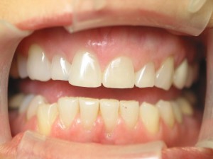 Short, square teeth Short, square teeth