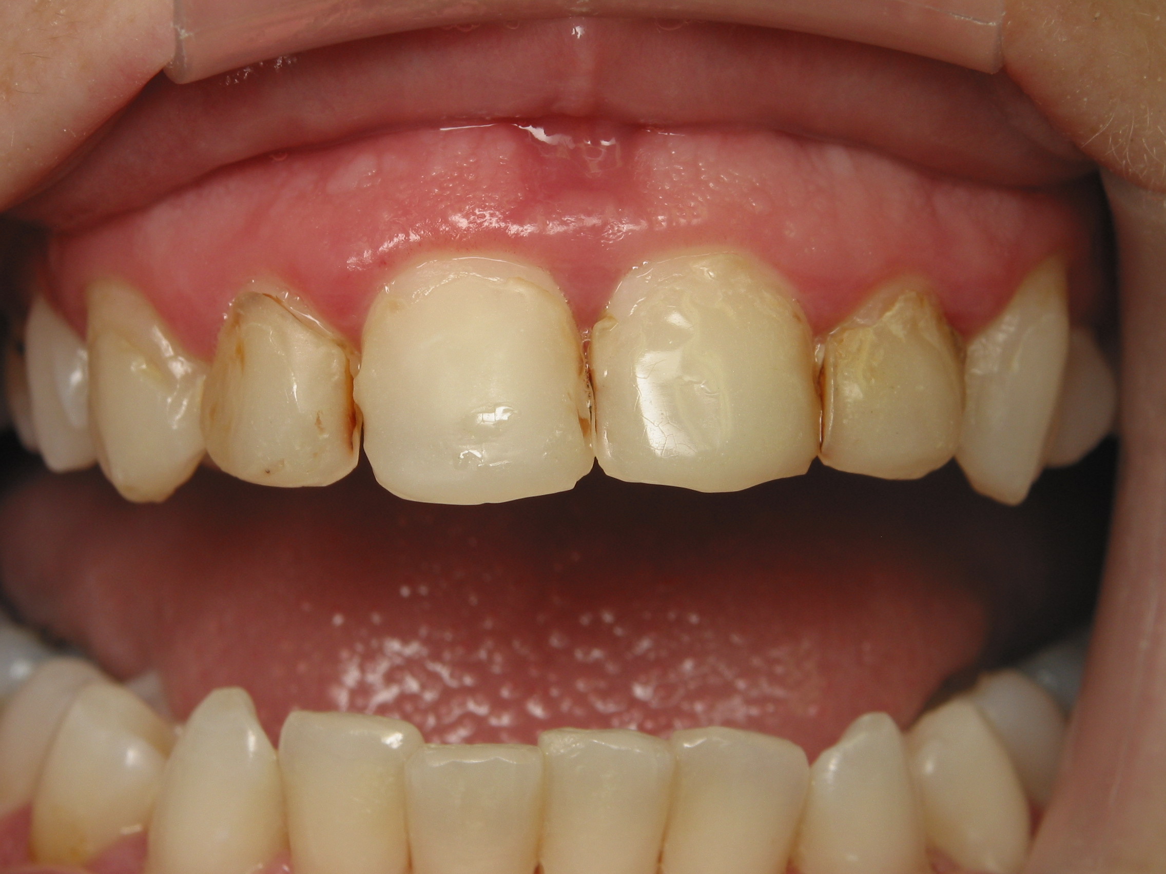 Veneers Vs Cosmetic Bonding Which Is Right For You Stovall Cheng Dds Pllc