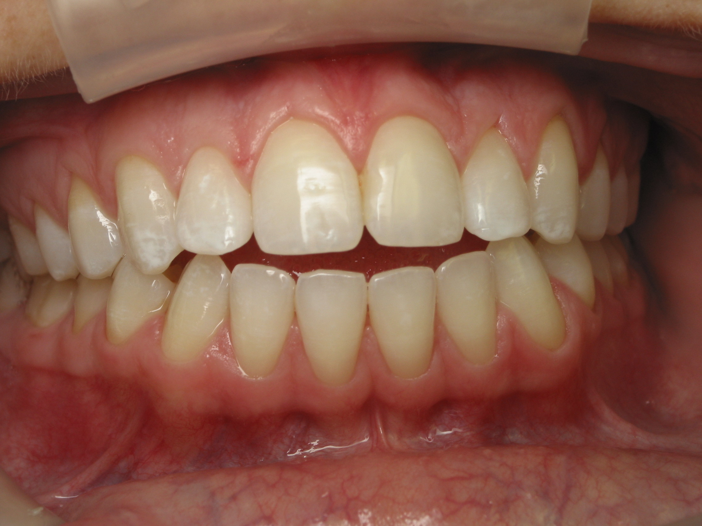 Invisalign helps open bites from tongue thrust - Stovall & Cheng DDS, PLLC