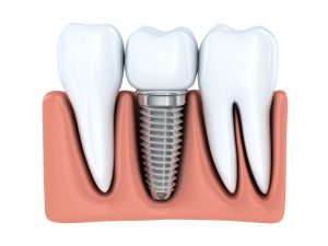 Dental implants in Fort Worth replace teeth and strengthen the jaw. Are they a suitable prosthetic for you? Find out from the experts at Hulen Dental.